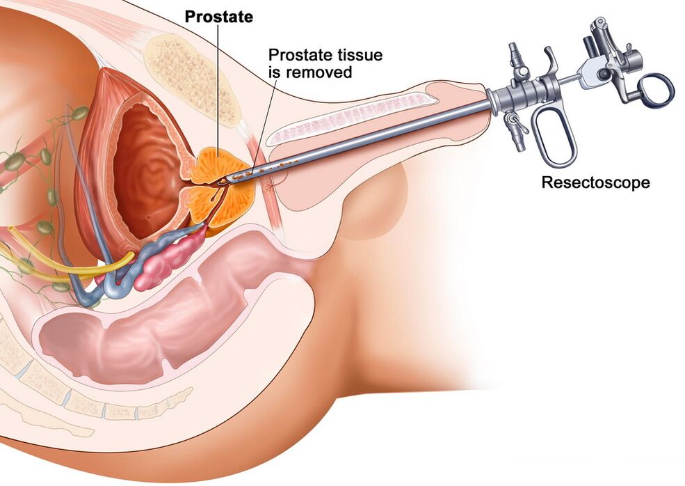 Odber tkaniva prostaty na presnú diagnostiku prostatitídy